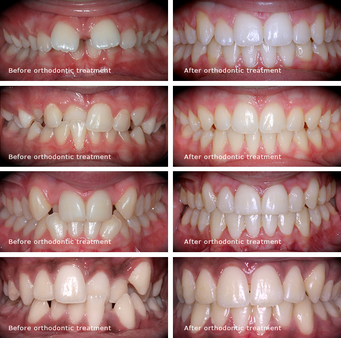 DENTAL BRACES before-after-cosmetic-braces-treatment