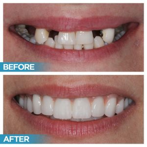 multiple dental implants Before-and-And-After