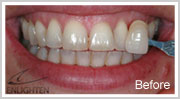 enlighten-teeth-whitening
